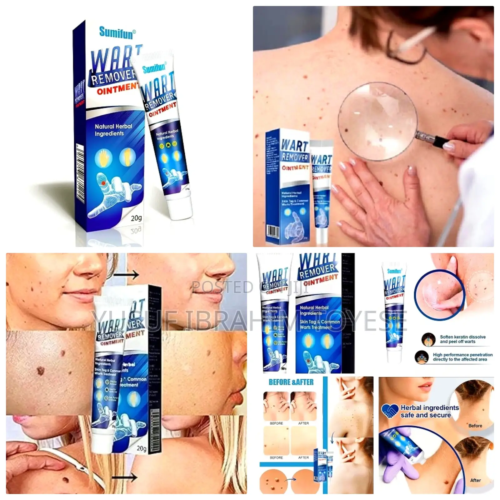 Natural and Fast Acting Skin Tag Removal