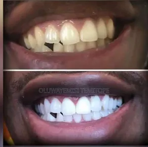 Teeth Whitening