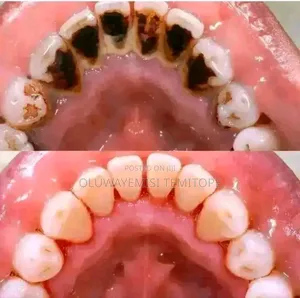 Scaling and Polishing