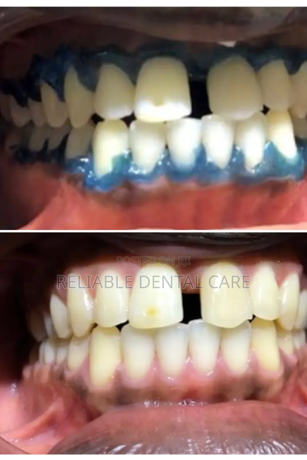 Teeth Whitening (Basic)