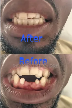 Dental Crown(Permanent Dental Replacement)