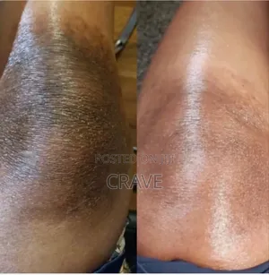 Mooyam Dark Kneels And Elbow Strong Whitening Cream
