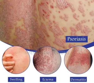 Psoriasis Relief/Remover Spray