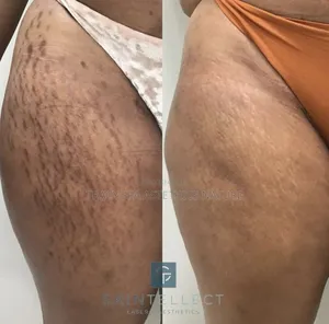 Stretch Marks Treatment