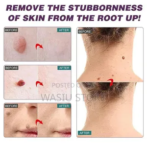 Skin Tag Removal Cream