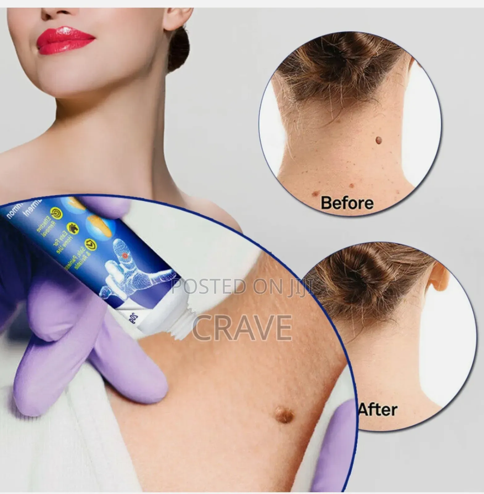 Instant Action Wart Removal - Remove Skin Tags Quick Wart Removal.