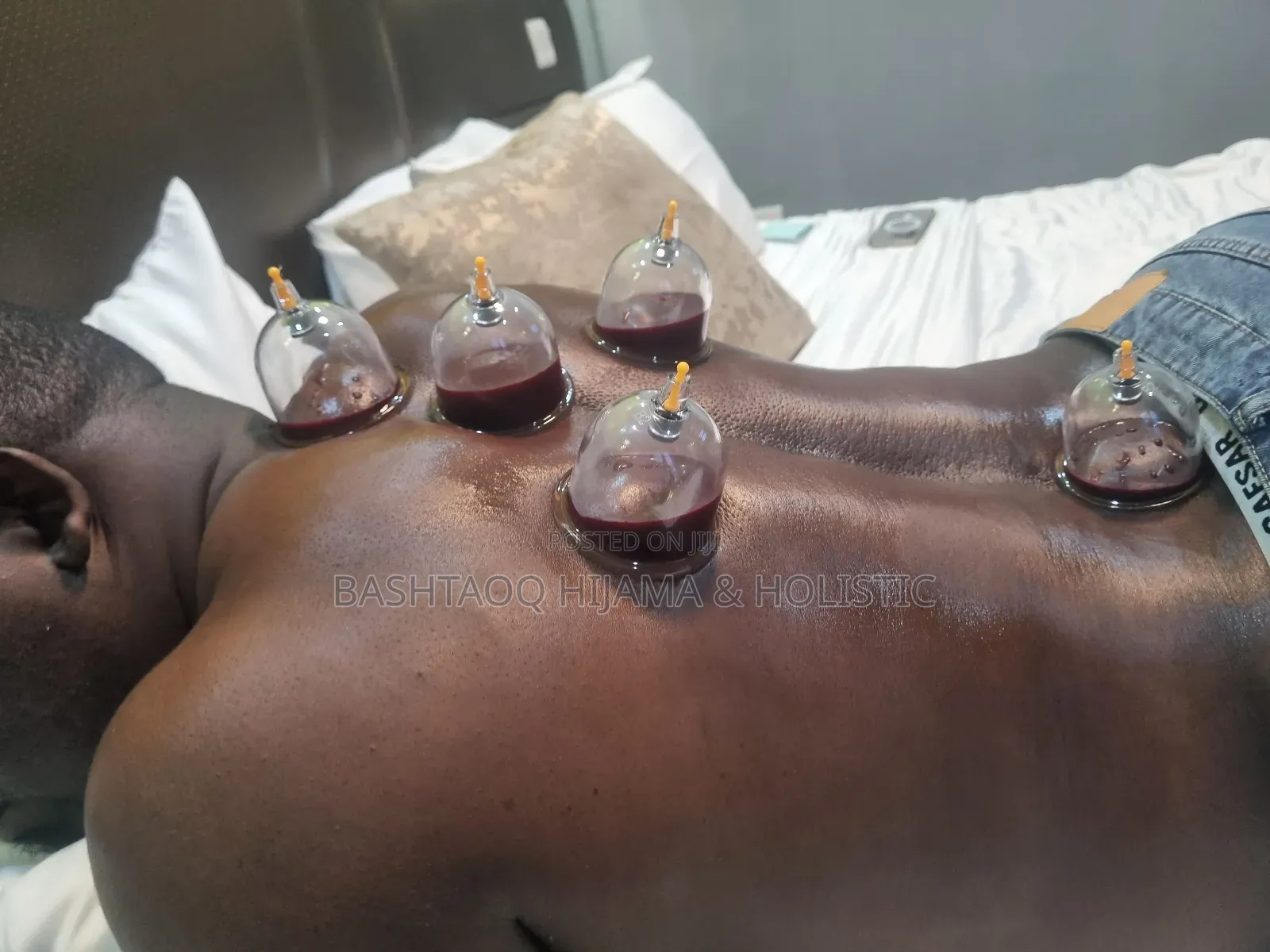 Hijama Therapy