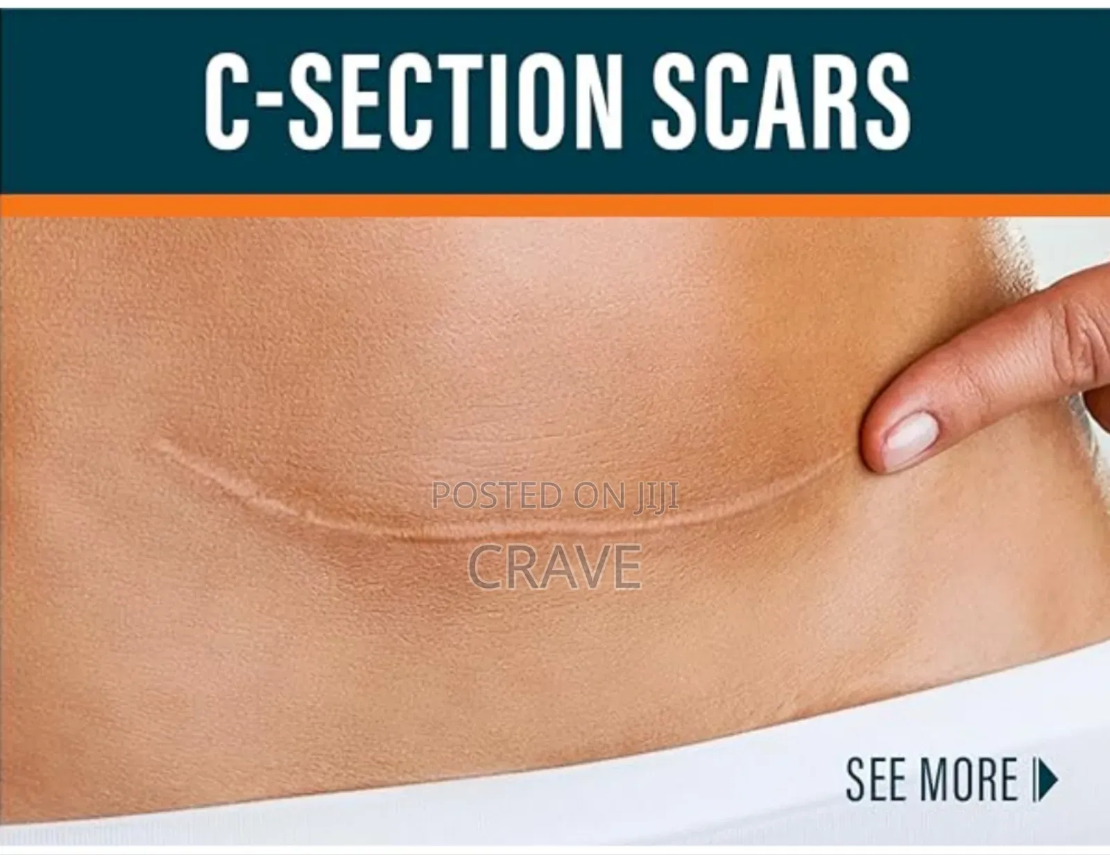 Kormesic Scar Sheet Treatment (1pcs)