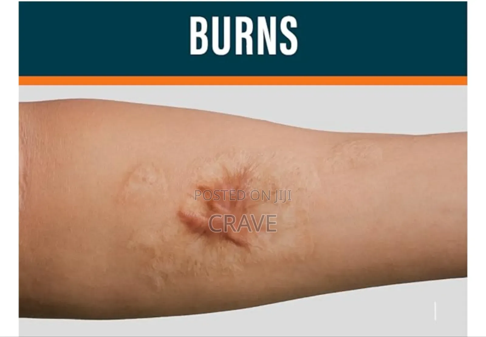Kormesic Scar Sheet Treatment (1pcs)