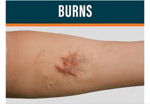 Kormesic Scar Sheet Treatment (1pcs)