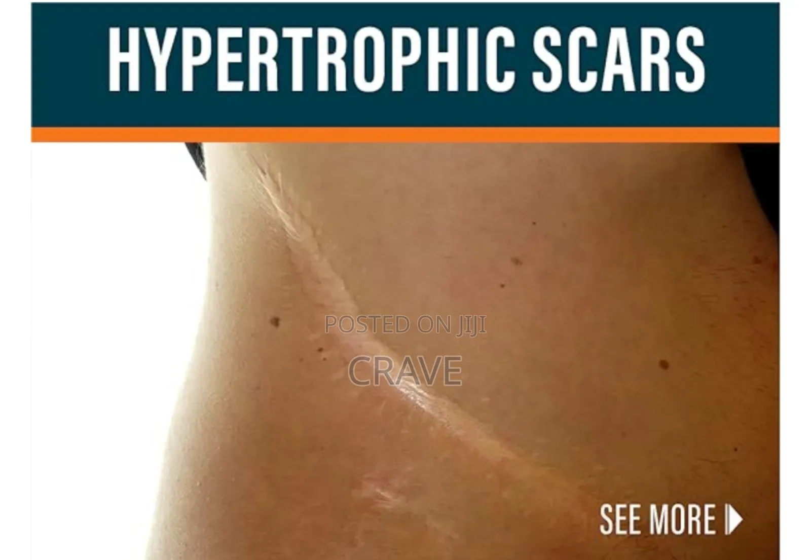 Kormesic Scar Sheet Treatment (1pcs)