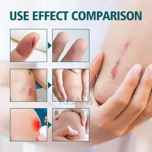 Triple Antibiotic Ointment for Fast Wounds Healing