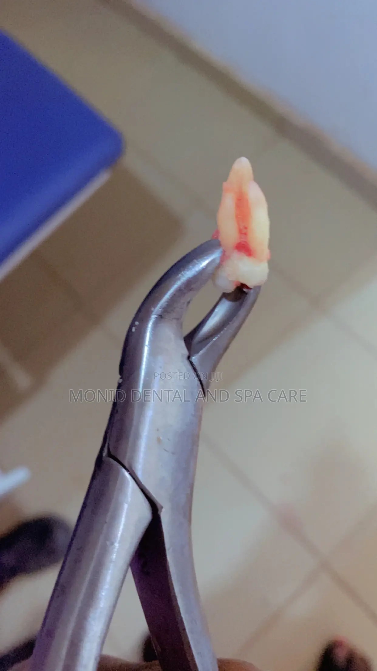 Teeth Extraction