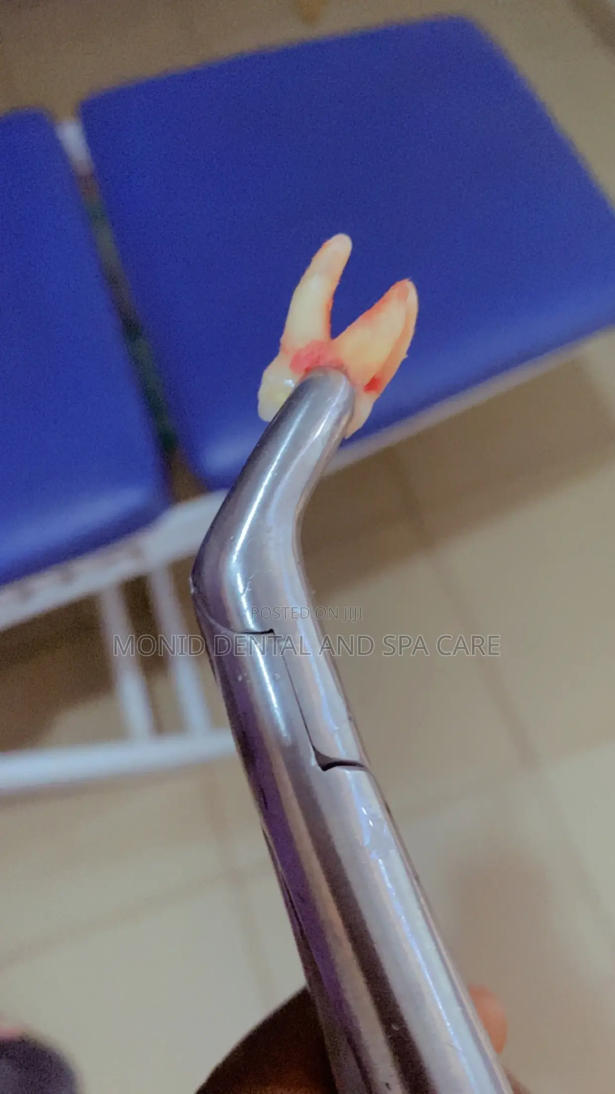 Teeth Extraction