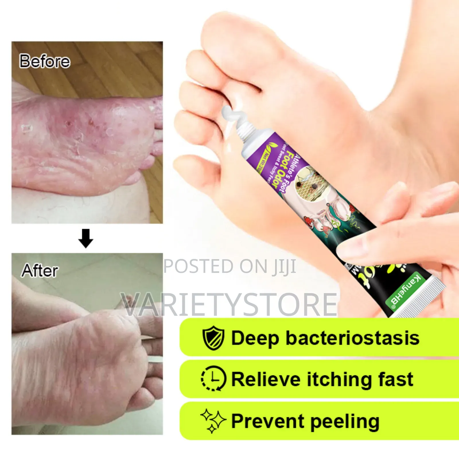 Foot Fungus Removal Cream Remove Beriberi