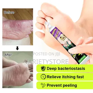 Foot Fungus Removal Cream Remove Beriberi