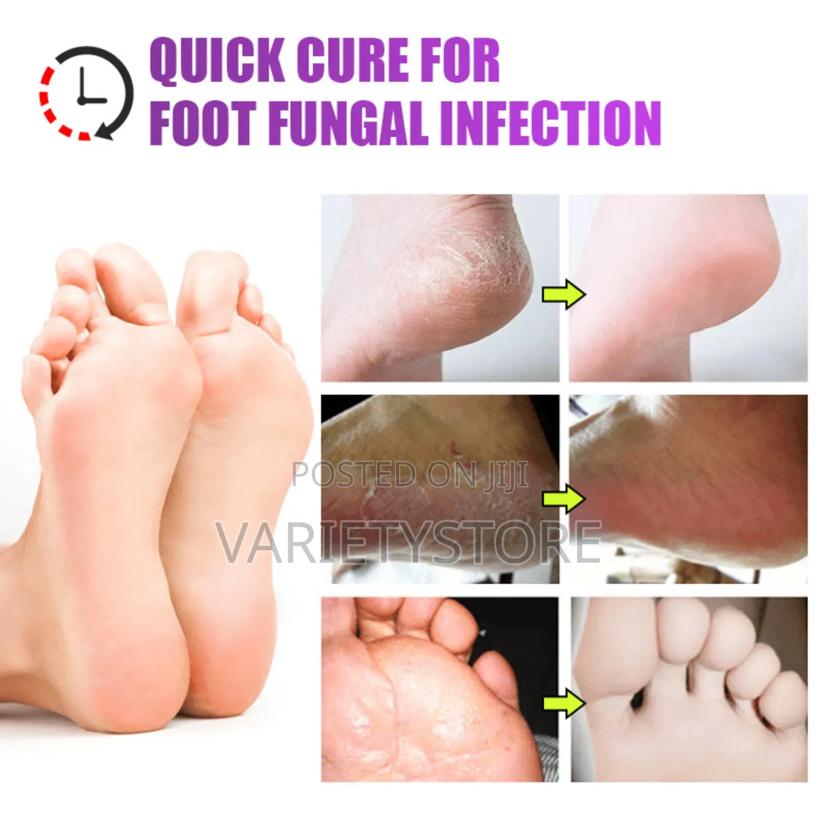 Foot Fungus Removal Cream Remove Beriberi