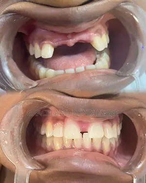Instant Teeth Replacement in Alimosho, Lagos/Kola/Ayobo/Abule-Egba