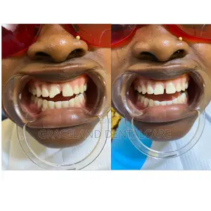 Teeth Filling in Alimosho/Alagbado/Ado-Odo Ota/Ayobo-Ipaja/Agege/Lagos