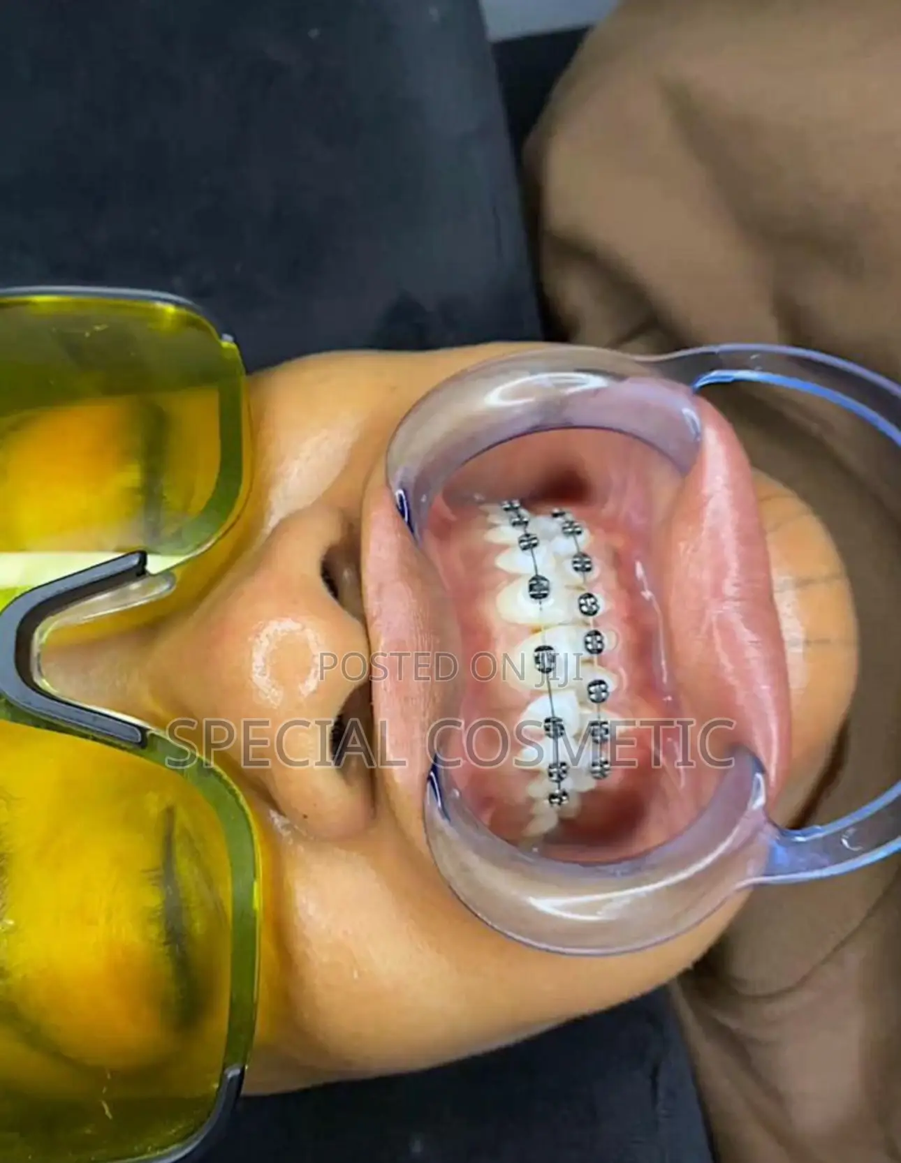 Fashion Braces