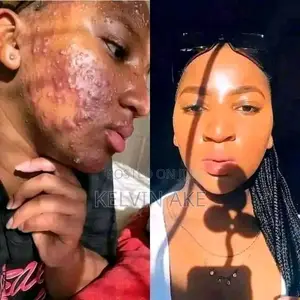 Acne Pimples Treatment Kit