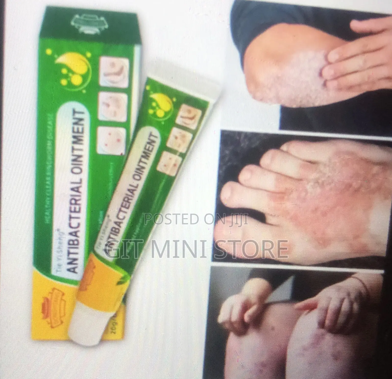 Antebacterial Ointment