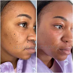 Skin Tag Remover and Teeth Whitening