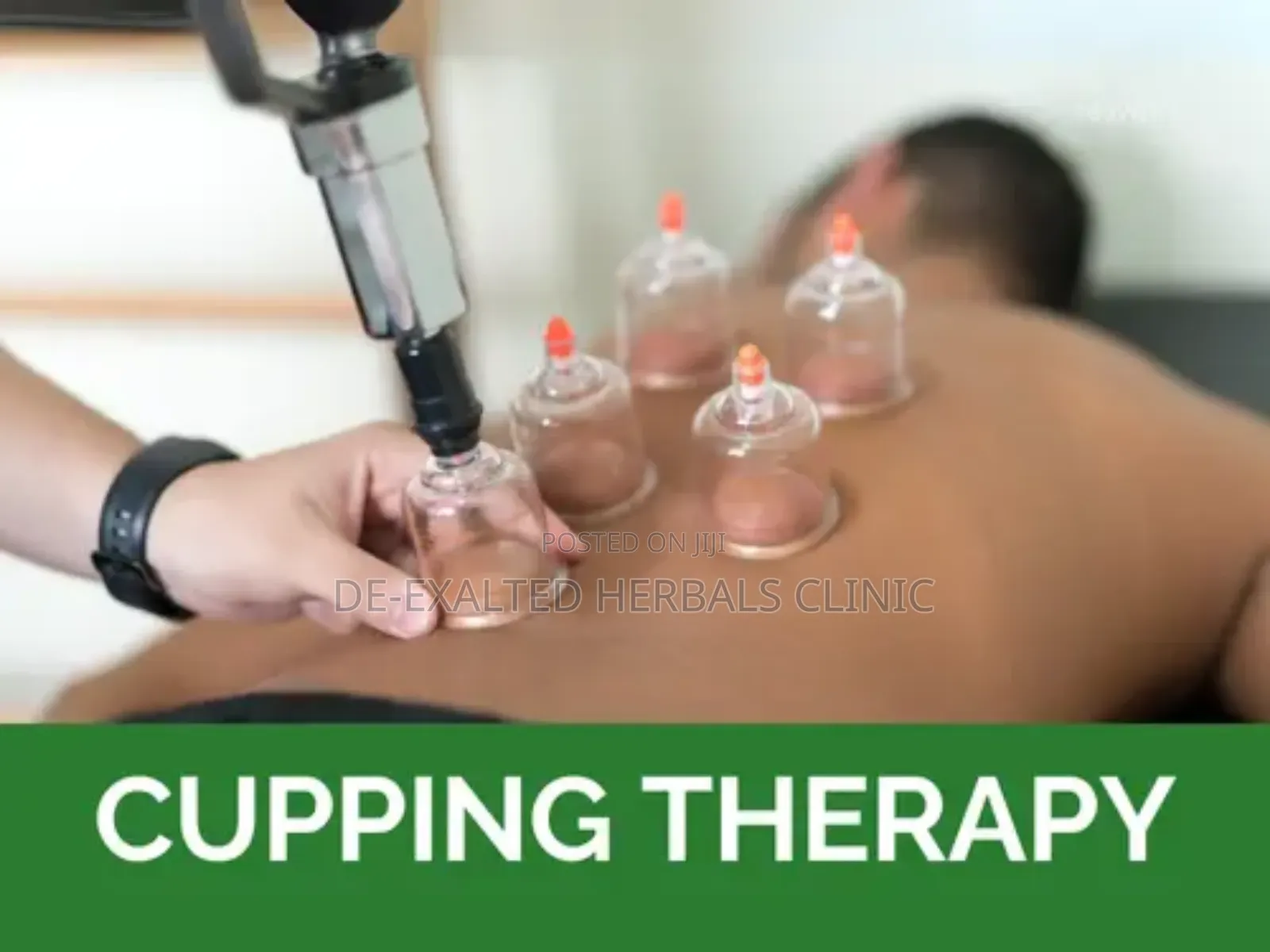 Cupping Therapy