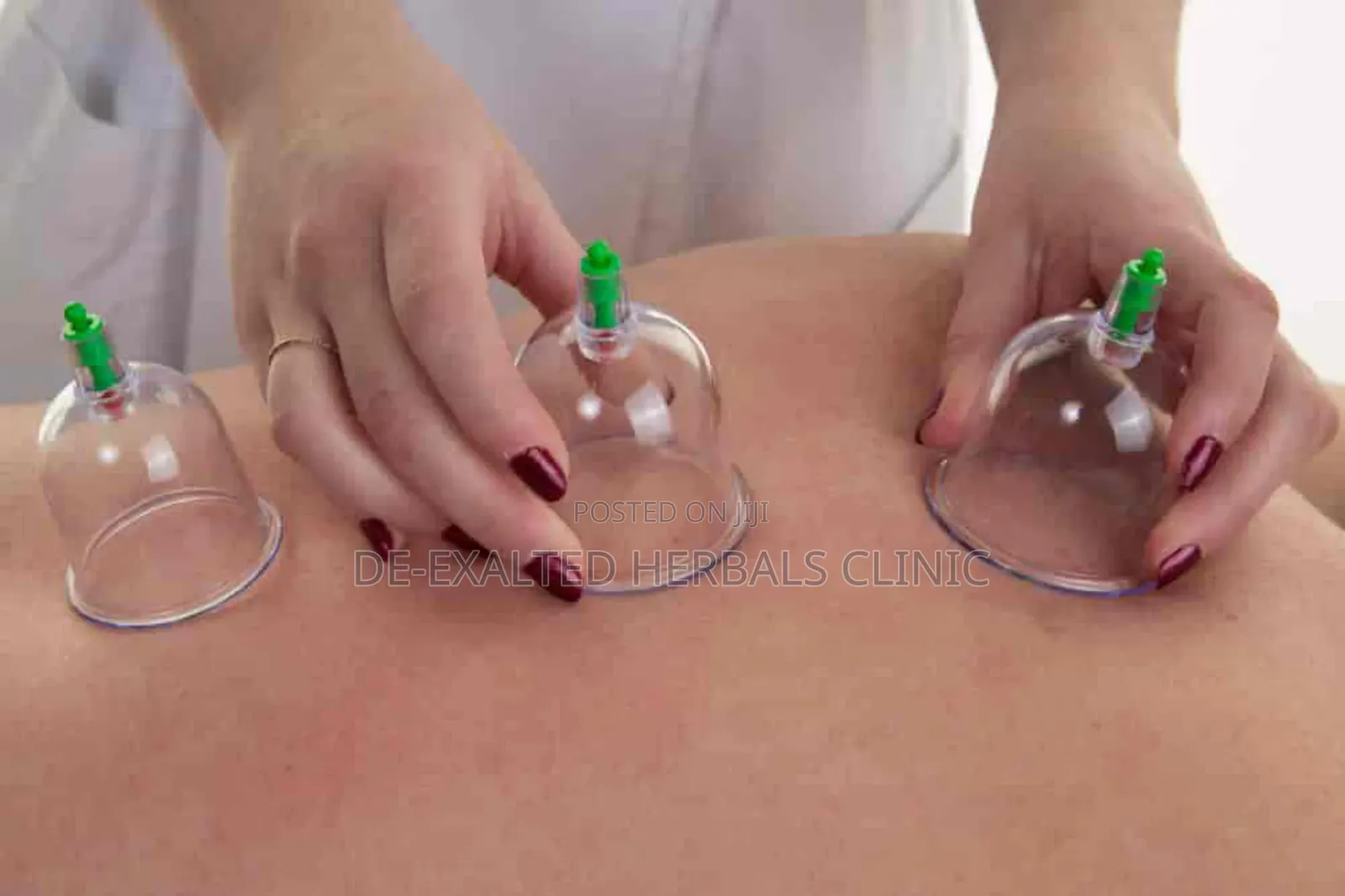 Cupping Therapy