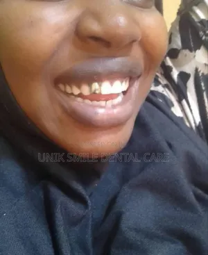Gold Crown at Affordable Price
