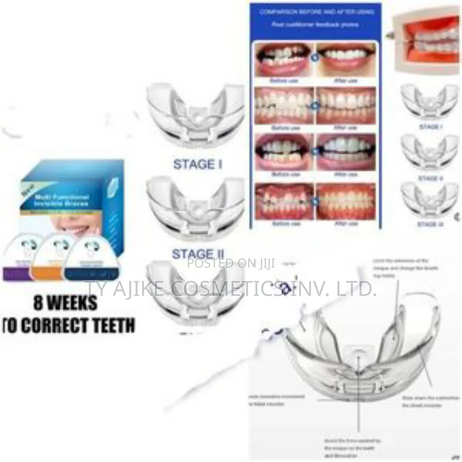 3 Stages Orthodontic Teeth Retainer