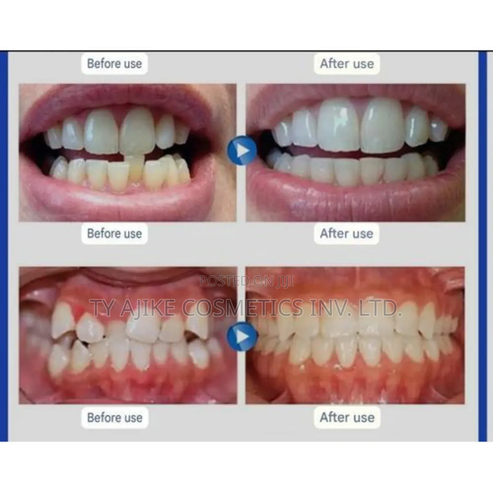 3 Stages Orthodontic Teeth Retainer