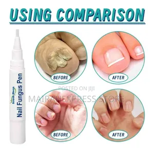 Southmoon Nail Fungus Pen (Cream) - Scientifically Certified Treatment