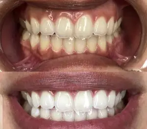 Teeth Whitening and Braces