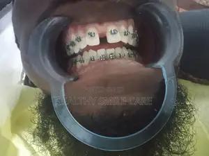 Teeth Whitening and Braces