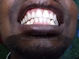 Teeth Whitening and Braces