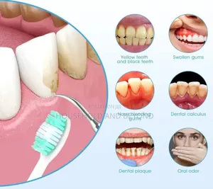 Electric Teeth Cleaner Calculus Remover