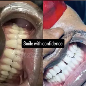 Teeth Whitening