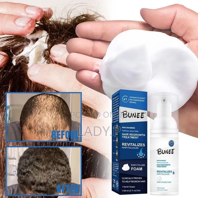Bunee Signature 5% Minoxidil Hair Growth Treatment, Aerosol 3 in 1