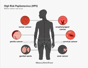 HPV Genital Warts Her S