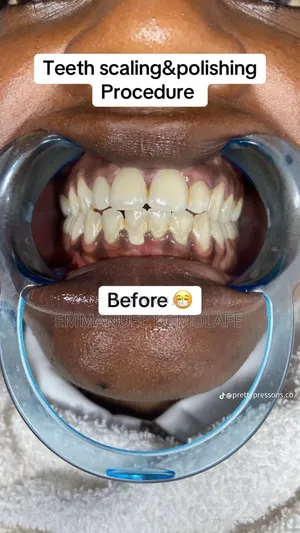 Scaling And Polishing