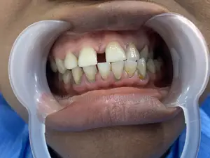 Scaling and Polishing ( Teeth Cleaning)