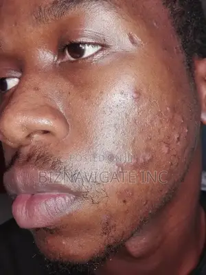 Ultimate Black Spots Terminator