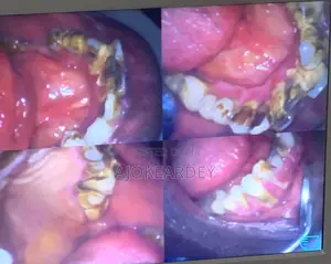 Professional Dental Cleaning(Scaling and Polishing)