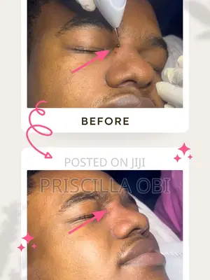 Professional Skin Tag Removal Service