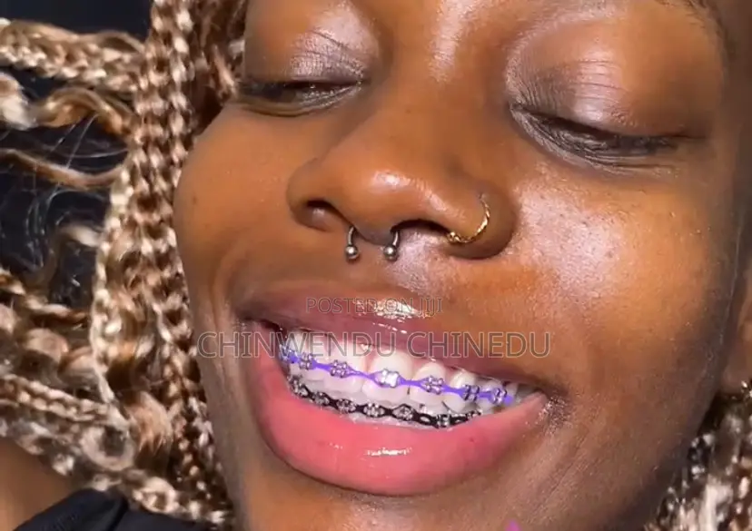 Fashion Braces