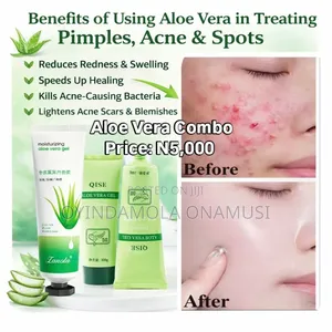 Aloe Vera Combo for Pimples