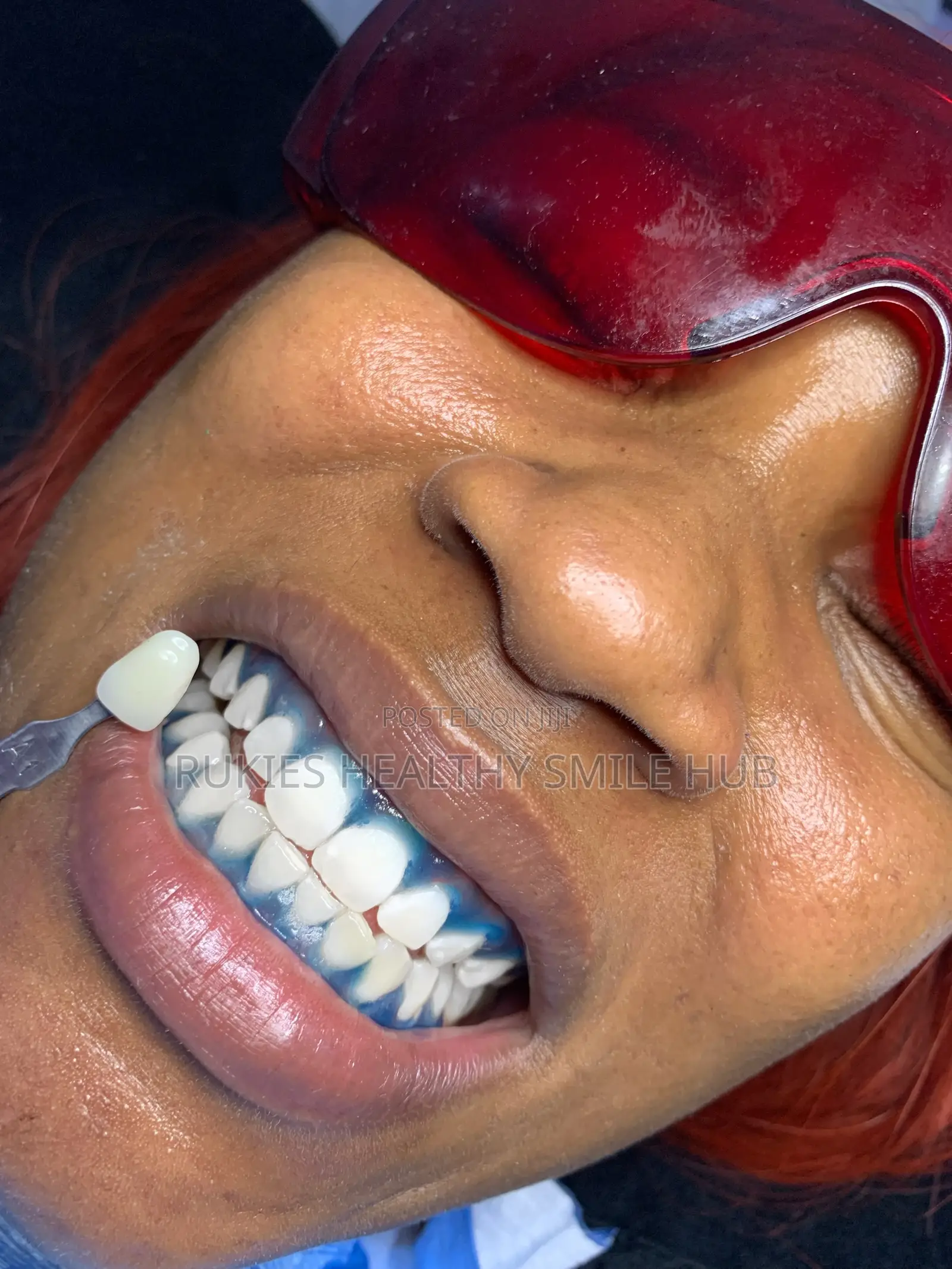 Basic Teeth Whitening