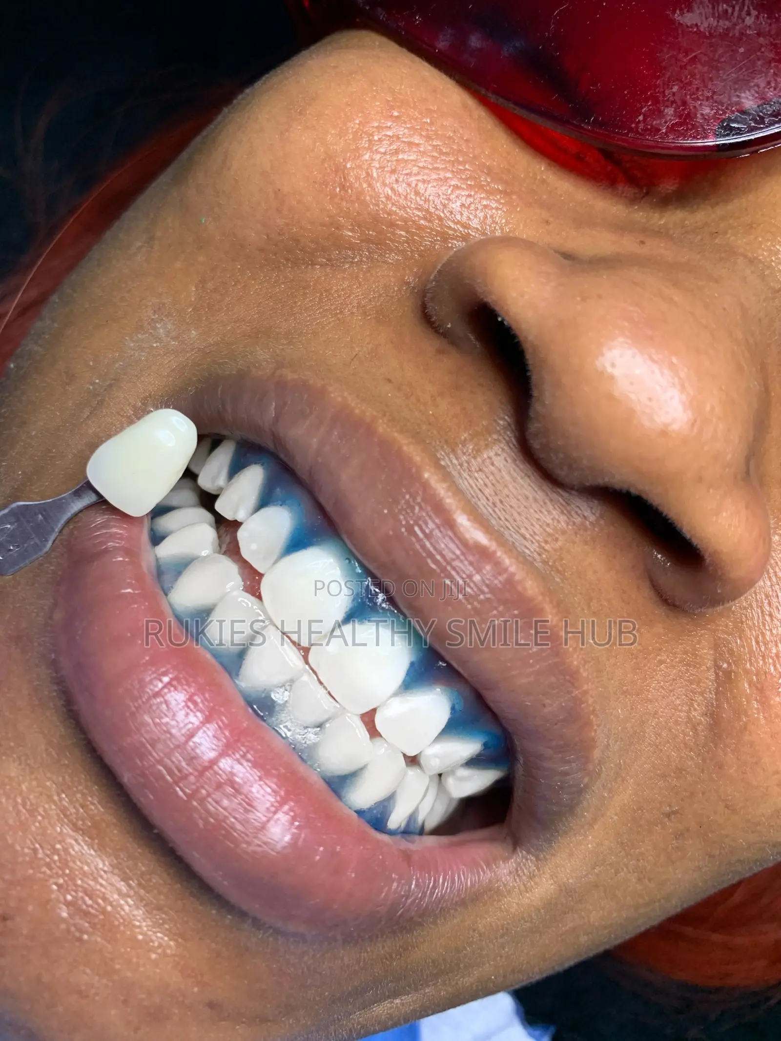 Basic Teeth Whitening