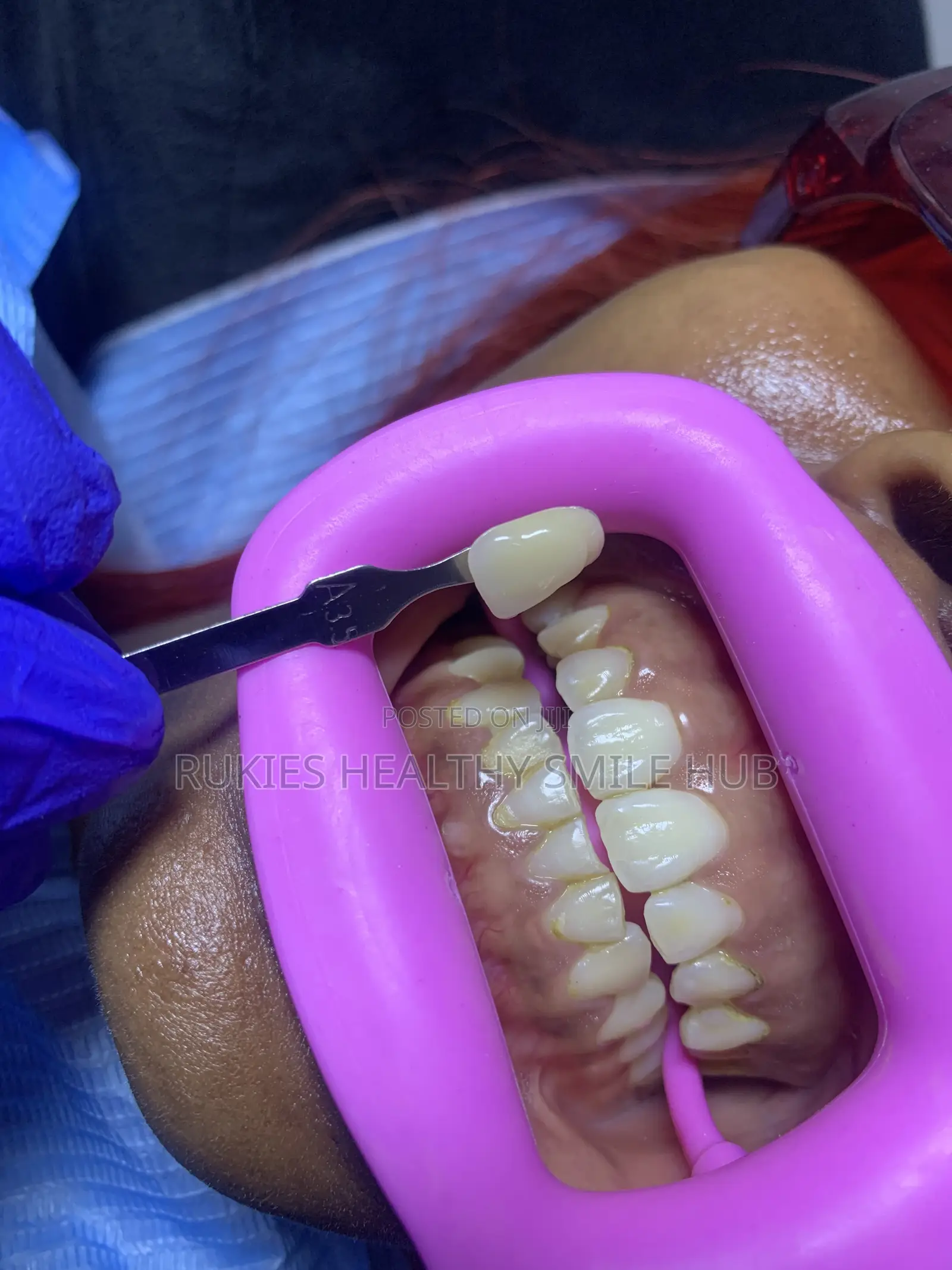 Basic Teeth Whitening